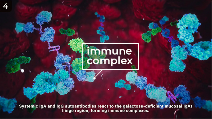immune-complex-iga-nephropathy